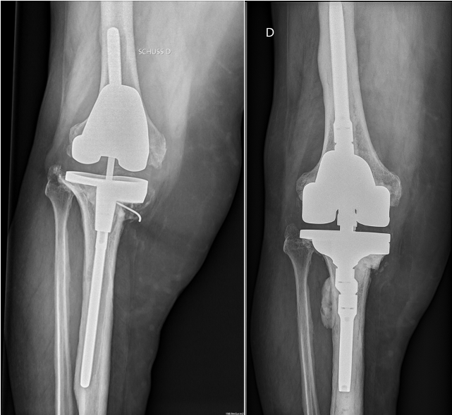 Descellement des implants_d_une prothese_totale_de genou